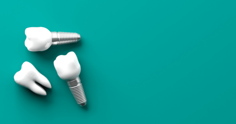 How Long Do Dental Implants Last? How Do You Preserve Them?