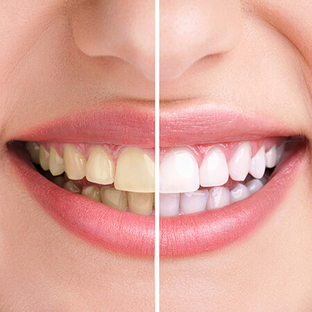 Close up of a patient before and after teeth whitening
